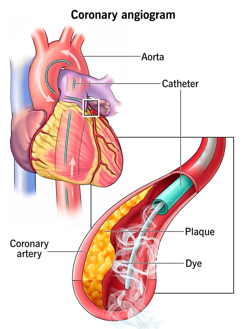 Angiography