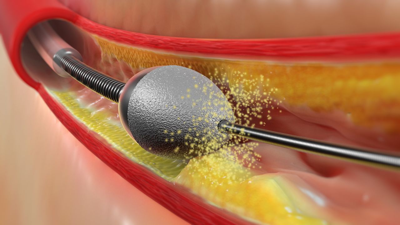 Rotablation Procedure