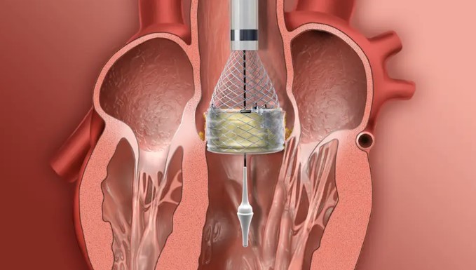 Transcatheter Aortic Valve Replacement (TAVR)